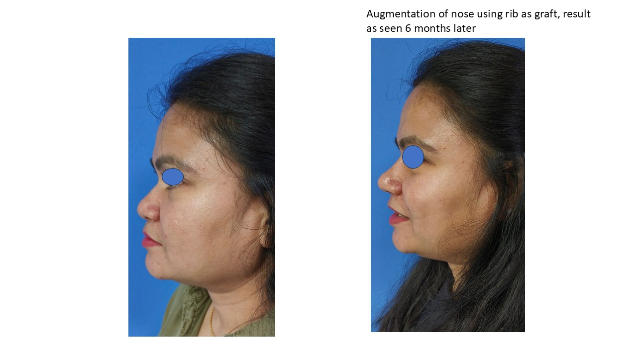 Rhinoplasty Photo 5